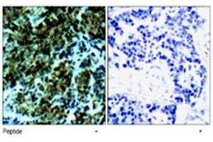 Immunohistochemical analysis of paraffin-embedded human breast carcinoma tissue, using Ctdp1 polyclonal antibody . (CTDP1 抗体  (N-Term))