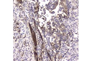 IHC testing of FFPE human colon cancer tissue with LC3A antibody at 1ug/ml. (MAP1LC3A 抗体)