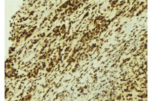 ABIN6274154 at 1/100 staining Human breast cancer tissue by IHC-P. (HNRNPC 抗体  (C-Term))