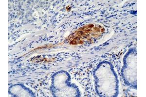 Immunohistochemistry staining of colon carcinoma (paraffin-embedded sections) with anti-p21 (WA-1). (p21 抗体)
