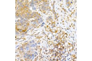 Immunohistochemistry of paraffin-embedded human esophageal cancer using CLIC4 Rabbit pAb (ABIN6127638, ABIN6138723, ABIN6138724 and ABIN6222890) at dilution of 1:50 (40x lens).