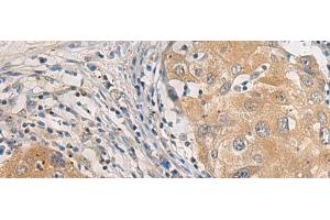 Immunohistochemistry of paraffin-embedded Human breast cancer tissue using AGAP3 Polyclonal Antibody at dilution of 1:25(x200) (AGAP3 抗体)