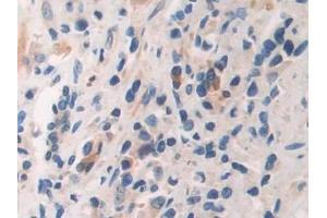 Detection of ARRb1 in Human Prostate cancer Tissue using Polyclonal Antibody to Arrestin Beta 1 (ARRb1)