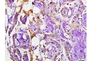 Formalin-fixed and paraffin embedded human colon carcinoma labeled with Rabbit Anti-MMP-7 Polyclonal Antibody, Unconjugated at 1:200 followed by conjugation to the secondary antibody and DAB staining. (MMP7 抗体  (AA 151-250))