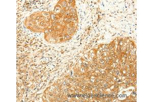 Immunohistochemistry of Human colon cancer using RARRES1 Polyclonal Antibody at dilution of 1:60 (RARRES1 抗体)