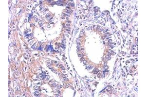 IHC-P Image Immunohistochemical analysis of paraffin-embedded human gastric cancer, using P2Y7, antibody at 1:500 dilution. (Leukotriene B4 Receptor/BLT 抗体)