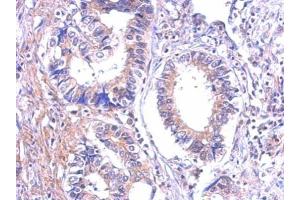 IHC-P Image Immunohistochemical analysis of paraffin-embedded human gastric cancer, using P2Y7, antibody at 1:500 dilution. (Leukotriene B4 Receptor/BLT 抗体)