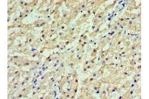 Immunohistochemistry of paraffin-embedded human liver cancer using ABIN7154092 at dilution of 1:100 (GSTa2 抗体  (AA 1-222))