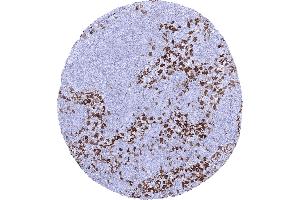 Strong factor XIII immunostaining of sinus histiocytes in a lymph node (F13A1 抗体  (AA 46-181))
