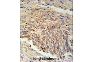 EBPL Antibody immunohistochemistry analysis in formalin fixed and paraffin embedded human lung carcinoma followed by peroxidase conjugation of the secondary antibody and DAB staining. (EBPL 抗体  (C-Term))