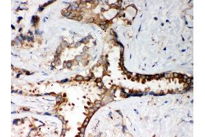 Anti- PP2A-alpha Picoband antibody, IHC(P) IHC(P): Human Lung Cancer Tissue