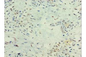 Immunohistochemistry of paraffin-embedded human breast cancer using ABIN7156607 at dilution of 1:100 (IL29 抗体  (AA 20-200))