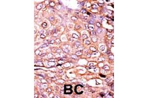 Formalin-fixed and paraffin-embedded human cancer tissue reacted with EP300 (phospho S89) polyclonal antibody  which was peroxidase-conjugated to the secondary antibody followed by AEC staining.