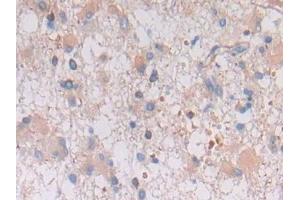 Detection of GFAP in Human Glioma Tissue using Polyclonal Antibody to Glial Fibrillary Acidic Protein (GFAP)