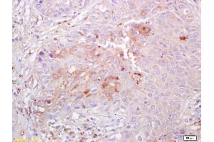 Formalin-fixed and paraffin embedded human lung carcinoma labeled with Anti Integrin alpha 3 Polyclonal Antibody , Unconjugated at 1:200, followed by conjugation to the secondary antibody and DAB staining (ITGA3 抗体  (AA 976-1025))