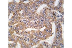 IHC analysis of FFPE human prostate carcinoma tissue stained with PAK4 antibody (PAK4 抗体  (AA 156-187))