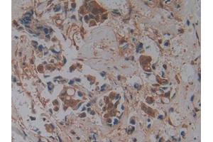 DAB staining on IHC-P; Samples: Human Breast cancer Tissue (GMFG 抗体  (AA 6-126))