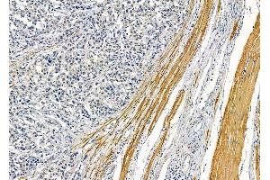ABIN6263078 and ABIN6278934 at 1/100 staining human prostate cancer by IHC-P. (MAGEF1 抗体  (Internal Region))