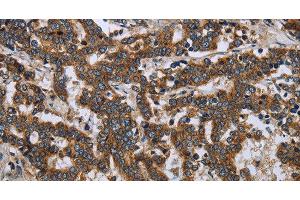 Immunohistochemistry of paraffin-embedded Human liver cancer tissue using LGALS2 Polyclonal Antibody at dilution 1:30 (Galectin 2 抗体)