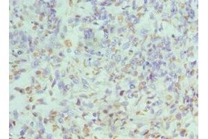 Immunohistochemistry of paraffin-embedded human endometrial cancer using ABIN7155102 at dilution of 1:100 (HNRNPD/AUF1 抗体  (AA 1-306))