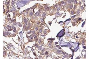 ABIN6267656 at 1/100 staining human breast carcinoma tissue sections by IHC-P. (NFKBIB 抗体  (pSer23))
