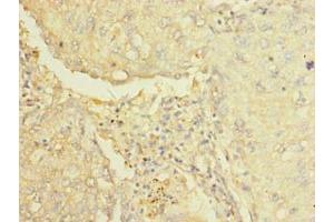 Immunohistochemistry of paraffin-embedded human lung cancer using ABIN7143633 at dilution of 1:100 (AARSD1 抗体  (AA 1-230))