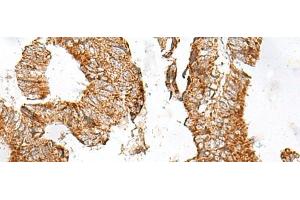 Immunohistochemistry of paraffin-embedded Human colorectal cancer tissue using GPR119 Polyclonal Antibody at dilution of 1:45(x200) (G Protein-Coupled Receptor 119 抗体)
