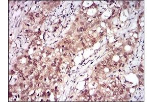 Immunohistochemical analysis of paraffin-embedded human cervical cancer tissues using RELB mouse mAb with DAB staining. (RELB 抗体  (AA 273-443))