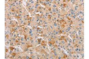 The image on the left is immunohistochemistry of paraffin-embedded Human liver cancer tissue using ABIN7128532(ARSF Antibody) at dilution 1/20, on the right is treated with fusion protein. (ARSF 抗体)