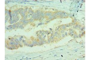 Immunohistochemistry of paraffin-embedded human colon cancer using ABIN7159680 at dilution of 1:100 (MICA 抗体  (AA 24-307))