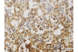 Immunoperoxidase of monoclonal antibody to ZNF496 on formalin-fixed paraffin-embedded human cholangiocarcinoma. (ZNF496 抗体  (AA 485-585))