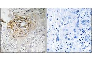 Immunohistochemistry analysis of paraffin-embedded human lung carcinoma tissue, using SCN9A Antibody. (SCN9A 抗体  (AA 651-700))