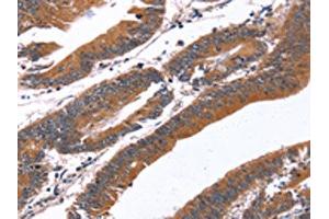 The image on the left is immunohistochemistry of paraffin-embedded Human colon cancer tissue using ABIN7190865(GREB1 Antibody) at dilution 1/40, on the right is treated with synthetic peptide. (GREB1 抗体)