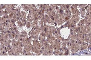 ABIN6277461 at 1/100 staining Human liver cancer tissue by IHC-P. (SSTR2 抗体  (C-Term))