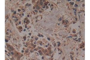 Detection of GCLM in Human Breast cancer Tissue using Polyclonal Antibody to Glutamate Cysteine Ligase, Modifier Subunit (GCLM) (GCLM 抗体  (AA 40-251))