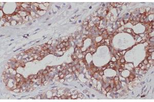 Immunohistochemistry of paraffin-embedded Human mammary cancer using TPD52 Polyclonal Antibody at dilution of 1:100 (40x lens). (TPD52 抗体)