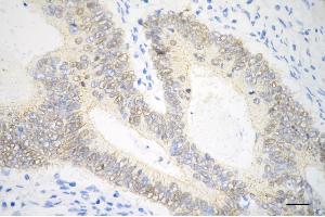 Immunohistochemistry was performed on paraffin-embedded human sigmoid colon carcinoma using catenin beta 1 antibody (ABIN7797936), 1:200). (Recombinant beta Catenin 抗体)