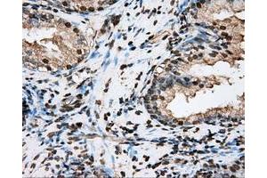 Immunohistochemical staining of paraffin-embedded Adenocarcinoma of ovary tissue N93ing anti-BSG mouse monoclonal antibody. (CD147 抗体)