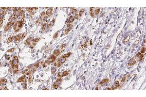 ABIN6278051 at 1/100 staining Human liver cancer tissue by IHC-P.