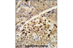 Formalin-fixed and paraffin-embedded human hepatocarcinoma reacted with NR1I2 Antibody , which was peroxidase-conjugated to the secondary antibody, followed by DAB staining. (NR1I2 抗体  (AA 100-127))