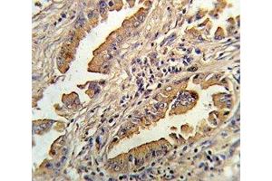 IHC analysis of FFPE human lung carcinoma stained with IL-8 antibody (IL-8 抗体  (AA 72-99))