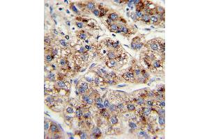 Formalin-fixed and paraffin-embedded human hepatocarcinoma with EHHADH Antibody , which was peroxidase-conjugated to the secondary antibody, followed by DAB staining.