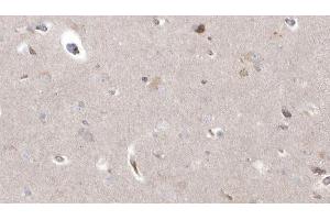 ABIN6273038 at 1/100 staining Human brain cancer tissue by IHC-P. (CYP26B1 抗体  (Internal Region))
