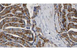 ABIN6267164 at 1/100 staining Human thyroid cancer tissue by IHC-P.