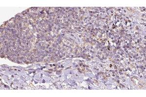 ABIN6273151 at 1/100 staining Human lymph cancer tissue by IHC-P. (Peroxiredoxin 5 抗体  (C-Term))