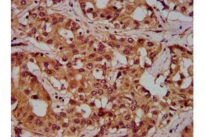 IHC image of ABIN7162774 diluted at 1:300 and staining in paraffin-embedded human liver cancer performed on a Leica BondTM system. (PGLYRP1 抗体  (AA 22-196))