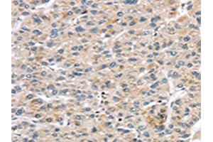 The image on the left is immunohistochemistry of paraffin-embedded Human liver cancer tissue using ABIN7191331(LZTS1 Antibody) at dilution 1/20, on the right is treated with synthetic peptide. (LZTS1 抗体)