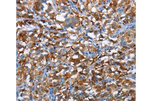 Immunohistochemistry of Human gastric cancer using CD226 Polyclonal Antibody at dilution of 1:60 (CD226 抗体)