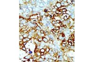 Formalin-fixed and paraffin-embedded human cancer tissue reacted with the primary antibody, which was peroxidase-conjugated to the secondary antibody, followed by AEC staining. (MAP4K2 抗体  (Middle Region))