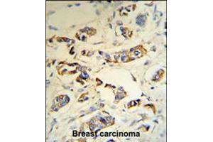 C1QA Antibody (RB18692) IHC analysis in formalin fixed and paraffin embedded human breast carcinoma tissue followed by peroxidase conjugation of the secondary antibody and DAB staining. (C1QA 抗体  (C-Term))